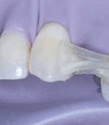 Без обточки зубов приклеивается прозрачный каркас