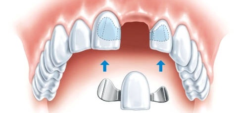 Установка адгезивного зубного протеза
