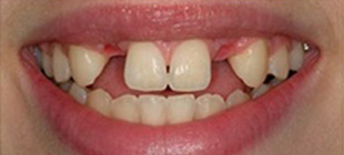 Состояние передних зубов до имплантации