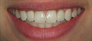 Результат после имплантации передних зубов до