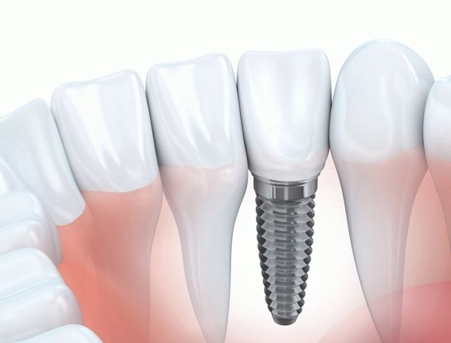 Восстановление зуба с помощью импланта