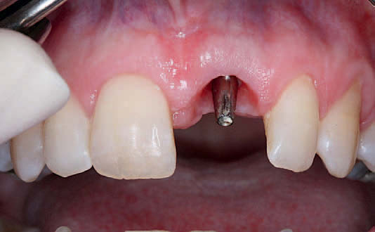 Имплант установленный сразу после удаления зуба