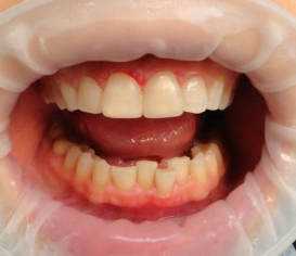 Результат реставрации верхних передних зубов