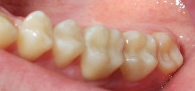 Результат реставрации нижних жевательных зубов
