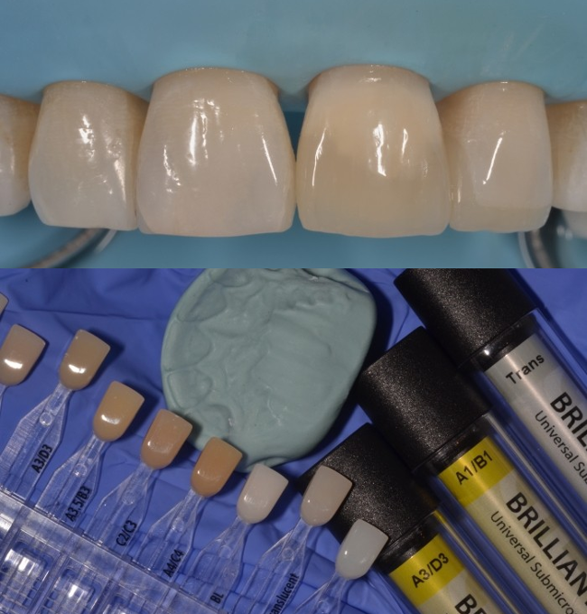 Реставрация зубов при помощи композитных пломб