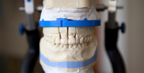 Протезирование зубов: возможности современной стоматологии