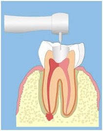 Вскрывается зуб, расчищается канал до прикорневого гнойника