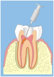 Пломбируют корневой канал
