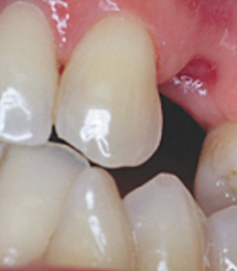 Удаленный зуб, который необходимо восстановить