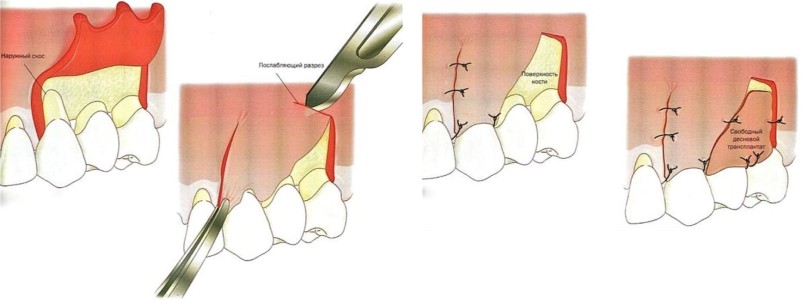 Этапы лоскутной пластики десны