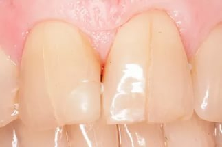 Трещина зубной эмали, необходимо насыщение витаминно-минеральными препаратами