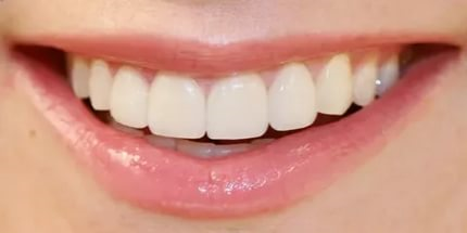 Здоровая эмаль зубов после реминерализации