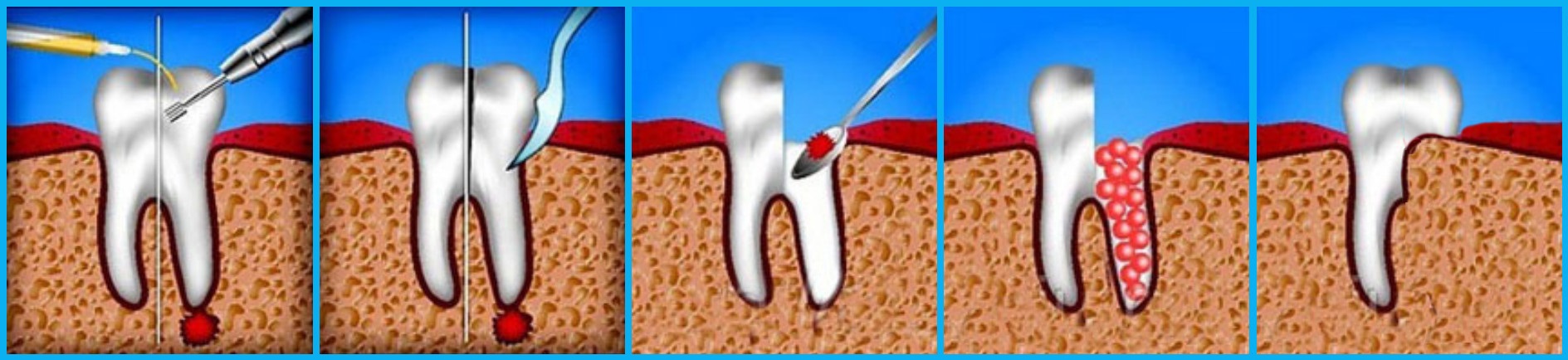 2 корня в зубе. Гемисекция и ампутация корня зуба. Резекция,ампутация,гемисекция корня. Гемисекция многокорневого зуба.