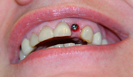 Установлен передний зубной имплант на верхней челюсти 