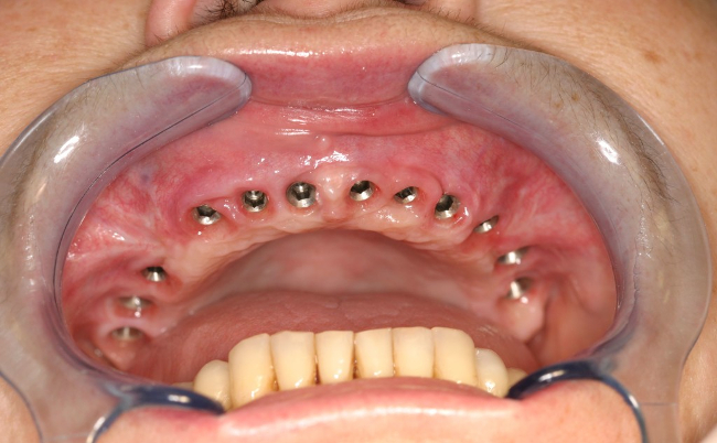 Полная имплантация всех зубов на верхней челюсти 