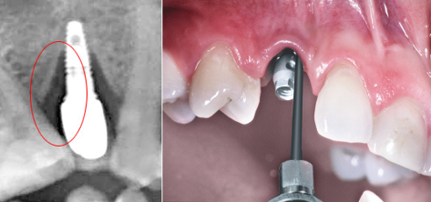 Переимплантит - одна из причин удаления зубного импланта