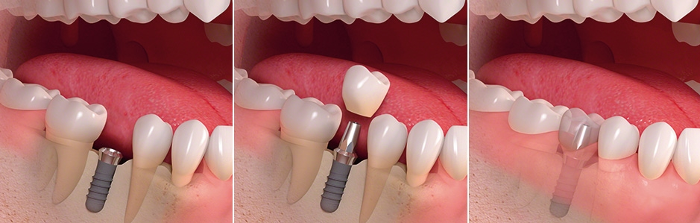 Установка зубного импланта за один этап