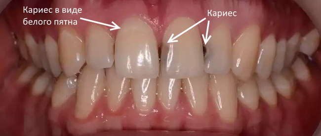 Пришеечный кариес фото, как лечить, причины возникновения