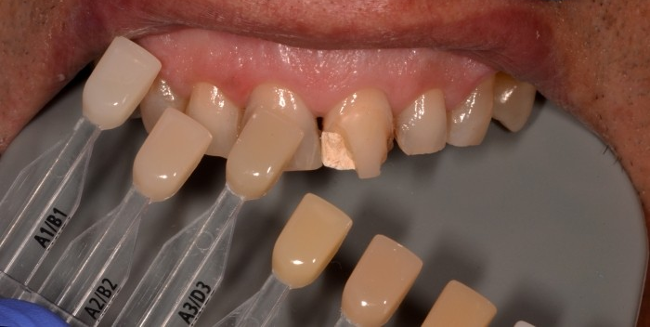 Композитная реставрация зубов
