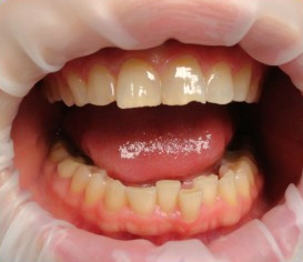 Сколы на передних верхних зубах до реставрации