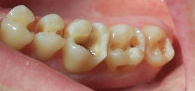 Глубокий кариес нижних жевательных зубов