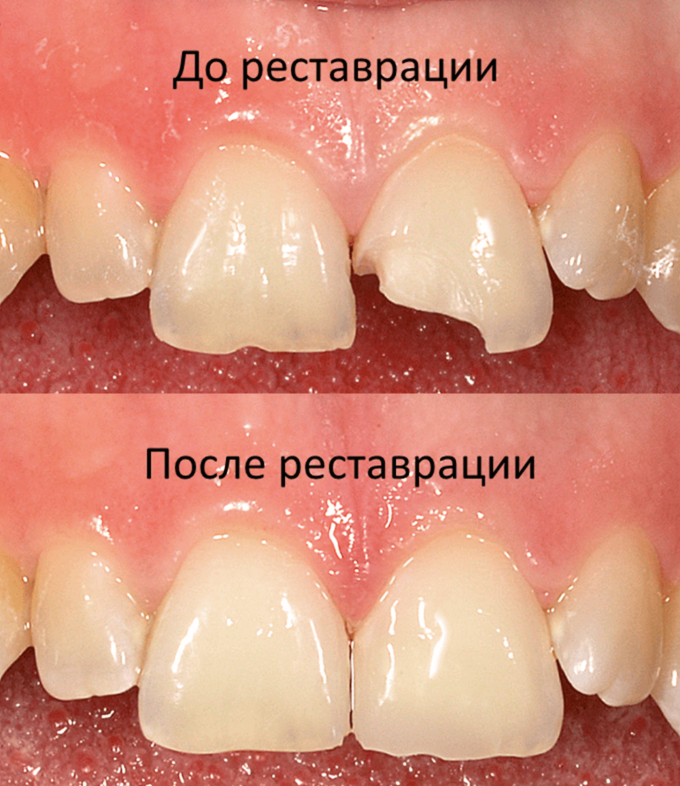 Реставрация зубов гибридной керамикой VITA ENAMIC