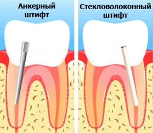 Коронка жевательного зуба на штифтах