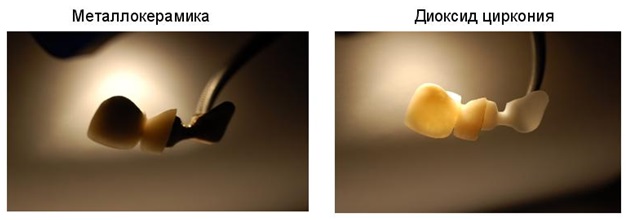Коронки из оксида диоксида циркония пропускаю свет, смотрятся наиболее естественно