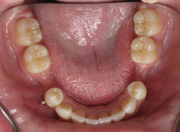 Материалы для протезирования зубов - описание разновидностей, что лучше