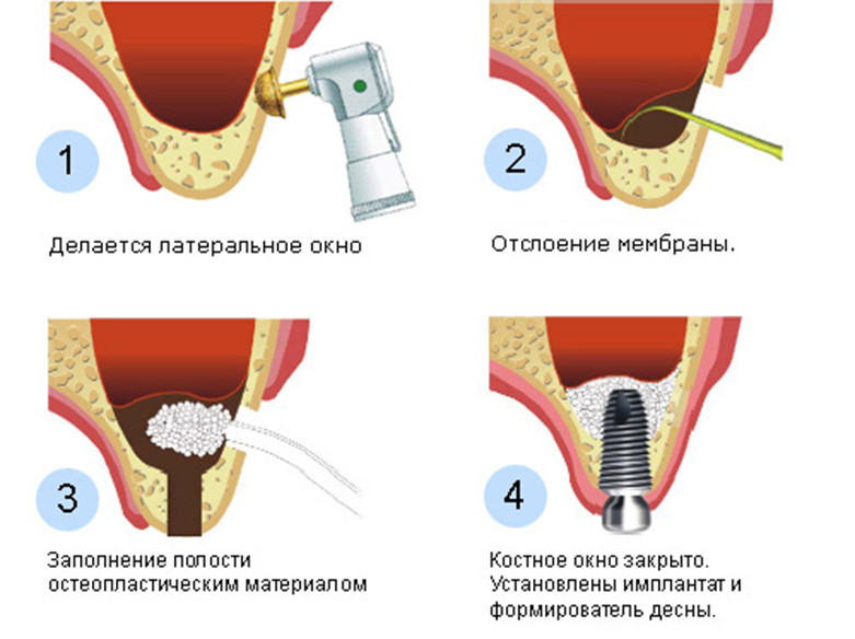 Синус-лифтинг при имплантации зубов