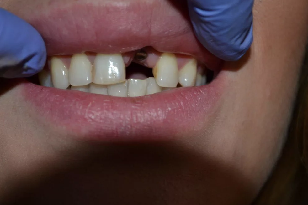 Почему опухает щека после удаления зуба