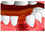 Кровотечение из лунки удаленного зуба