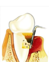 Атрофированный пародонт вызванный прикорневым кариесом