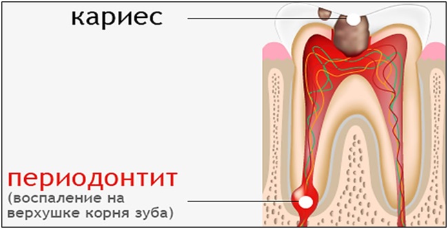 Периодонтит - воспаление на верхушке коня зуба