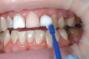 Насыщение эмали зубов витаминно-минеральными препаратами
