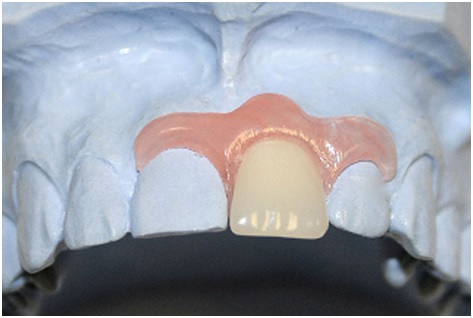 Протез-бабочка на передний верхний зуб