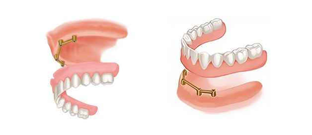 Балочные протезы на имплантах для верхней и нижней челюсти