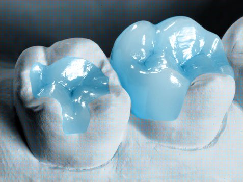 Протезы-вкладки для восстановления не полностью разрушенных зубов