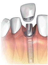одиночная коронка на импланте, замещает один отсутствующий зуб
