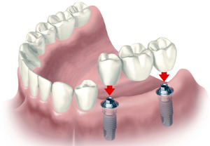мост на имплантах замещает несколько отсутствующих зубов или даже всю челюсть