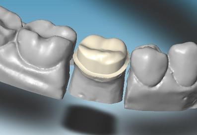 Компьютерное моделирование каждого зубного протеза