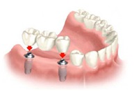 Протезирование зубов несъемное