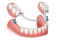 Протезирование зубов съемное
