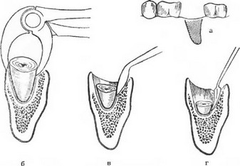 Удаление корня зуба
