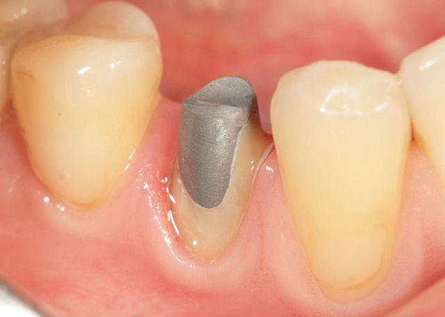 Восстановление разрушенного зуба внутрикорневой вкладкой