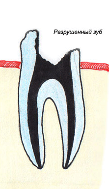 Внутрикорневые вкладки для восстановления зуба