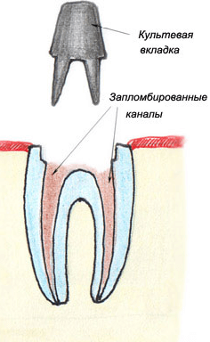 Подготовка зуба для внутрикорневой вкладки