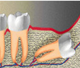 Дистальное погружение зуба мудрости