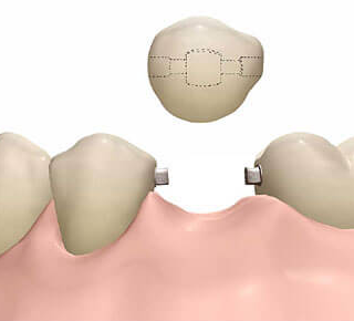 Установка замков в соседних зубах с частичным повреждением эмали и дентина