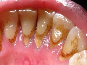 Зубной камень, налет или кариес: в чем отличия?
